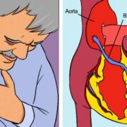 Coronary Heart Disease