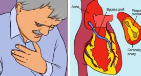 Coronary Heart Disease