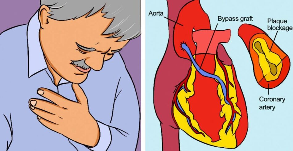 Coronary Heart Disease